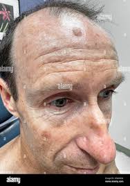 Image result for Solar Lentigo