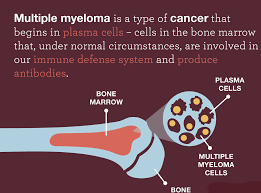 It's not clear what causes myeloma. New Treatment Protocol For Previously Untreatable Multiple Myeloma Using Selinexor Thailand Medical News