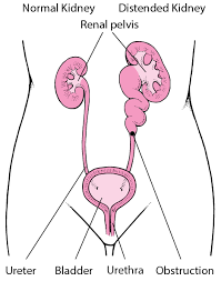 Urinary Tract Obstruction Kidney And Urinary Tract Disorders Msd Manual Consumer Version