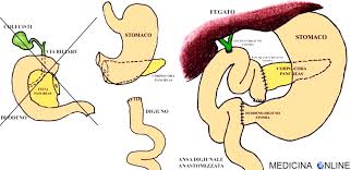 La sopravvivenza dai tumori tende ad abbassarsi quando la presenza di colesterolo ldl è più alta. Duodenocefalopancresectomia Complicanze Dieta Sopravvivenza Medicina Online