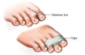 Hammer Toe Taping The Toe Doctor Hammer Toe Hammer Toe Correction Hammertoe Remedies