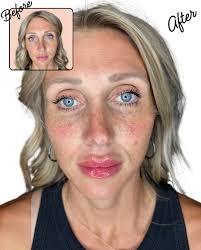 We thank you for your patience while we continue to grow and train our  team! Face Reality and our acne bootcamp will be back soon! 💙 👩🏼‍⚕️Deanna  Holt, CRNA DNP @fayettevilles.injector.boss 👩🏻‍⚕️Abby