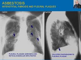 Either diffuse interstitial fibrosis or lung cancer to asbestos. Interstitial Restrictive Lung Diseases 1 Gail Feinberg Do