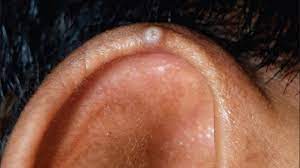Chondrodermatitis Nodularis Helicis Symptoms And More