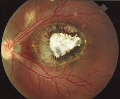 Macular Scar Secondary To Congenital Toxoplasmosis