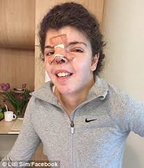 Lilli Sim overcame rare facial condition CFND now living life like a normal  teenager