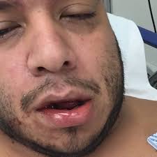 Fundraiser for Lori Aparicio-Doe by Pedro Aparicio : Jaw surgery and  hospital stay