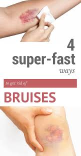 Pin On Home Remedy Tips