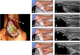 Image result for Epicondyle Injection