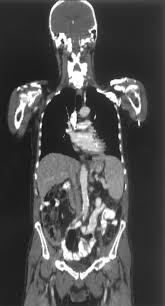 Image result for CT Intravenous Contrast