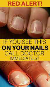 Red Alert If You See This On Your Nails Immediately Visit A Doctor White Lines On Fingernails You Nailed It White Dots On Nails
