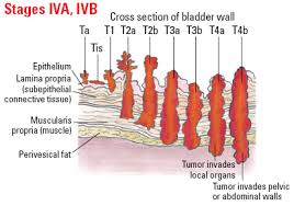 Image result for Bladder Cancer Staging