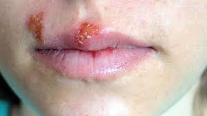 This picture shows herpetic keratitis, a herpes infection that involves the cornea, or the outside covering of the eye. Is It Herpes Or Something Else Everyday Health