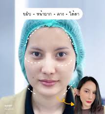 ฟิลเลอร์ 7 CC: วิวัฒนาการหน้าเด็กในเวลาไม่นาน