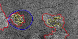 While there is an observed increase in cases, there is no definitive evidence of a surge in the national capital region, the department of. Optical Coherence Tomography Angiography Compared With Indocyanine Green Angiography In Central Serous Chorioretinopathy Scientific Reports
