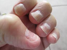 ظهور خط خفيف جدا في اختبار الحمل قبل موعد الدورة. Ø£Ù…Ø±Ø§Ø¶ Øª Ø®Ø¨Ø±Ùƒ Ø¨Ù‡Ø§ Ø£Ø¸Ø§ÙØ±Ùƒ Ø³Ø±Ø·Ø§Ù† Ø§Ù„Ø¬Ù„Ø¯ Ø£Ø­Ø¯Ù‡Ø§ Ù…ÙˆÙ‚Ø¹ Ù‚Ù†Ø§Ø© Ø§Ù„Ù…Ù†Ø§Ø± Ù„Ø¨Ù†Ø§Ù†