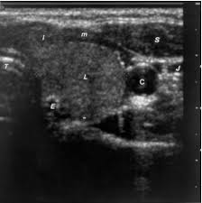 Ultrasonography Of The Thyroid Endotext Ncbi Bookshelf