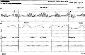 Image result for Cheyne-Stokes Respiration