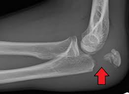 The triceps muscle tendon of the back of the arm attaches to the olecranon. Olecranon Fracture Wikipedia