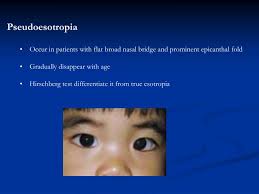 Epicanthal folds are folds in the inner corner of the eye secondary to a flat mid face or a smaller than usual nasal bone. Flat Nasal Bridge And Epicanthal Folds Fold And By Nasal Bridge Augmentation Perubahan Dangdut Di Indonesia