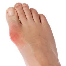 Foods To Avoid If You Have Gout Gout Recipes Gout Diet Gout Symptoms