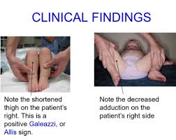 Image result for Galeazzi Sign