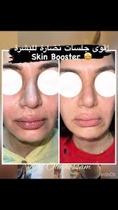 خصم ٥٠٪؜ على جلسات ال skin Booster , 📌 ال skin booster يتكون من ,  هايلويورونيك اسيد مركز عشان يدي نضارة قوية جدا للبشرة 🤩, 📌 بيشد الجلد ,  📌 بيعالج التجاعيد , 📌 بيخلي بشرتك تطلع الكولاجين بتاعها ف يحسن ...