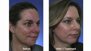 Check spelling or type a new query. Acne Scar Treatment With Fractional Co2 Laser Youtube