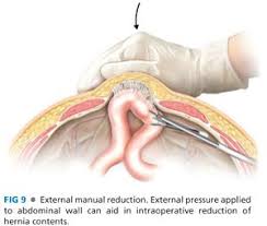 Image result for Hernia Reduction