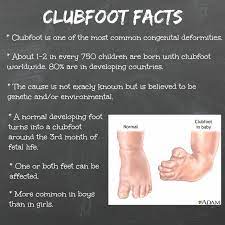 Clubfoot is a defect in which the foot is twisted out of shape or its position during birth. Baby Clubfoot Causes