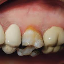 Start this program several months before your amalgams are removed, adding it onto your established nutritional regimen. Pdf Treatment Of Amalgam Tattoo With An Er Cr Ysgg Laser