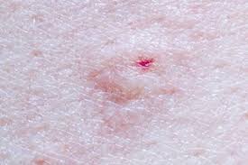 Typically, a spider bite looks like any other bug bite — a red, inflamed, sometimes itchy or painful bump on your skin — and may even go unnoticed. Insect Bites And Stings Symptoms Nhs
