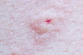 In fact, spiders usually like to keep to themselves and if your child is bitten by a spider, expect a reaction similar to a bee sting — like redness and swelling — and make her feel better with these tips on. Insect Bites And Stings Symptoms Nhs