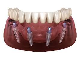 كل الأسنان مرتكزة على أربع أسنان مغروسة esdent dental centre