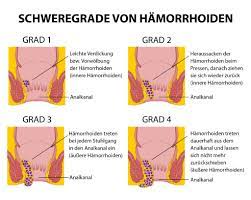 Veraltete bezeichnungen blinde adern, goldene adern, goldadern), sind arteriovenöse gefäßpolster, die ringförmig unter der enddarmschleimhaut angelegt sind und dem feinverschluss des afters dienen. Was Sind Anzeichen Fur Hamorrhoiden