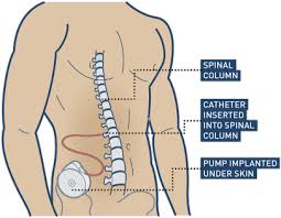 Image result for Intrathecal Pump