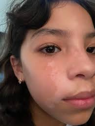 Tratamientos para el vitiligo