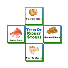 Kidney Stone Removal Surgery In Moga Punjab Symptoms