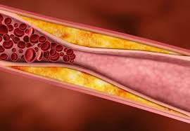 Pojem trombózy je odvodený od gréckeho slova thrombosis, ktoré možno preložiť ako zrážanie. Mozganska Venska Tromboza Simptomi Krcnezile Icu Krcnezile Icu