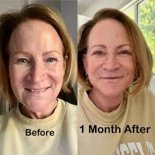 For the entirety of my 61 years I have avoided any type of conflict or  confrontation. So a couple of weeks ago when I posted something about  having had facelift surgery I