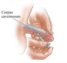 Helping with Impotence (Erectile Dysfunction)