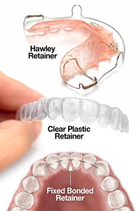 What are the types of orthodontic retainers? | Kirkintilloch