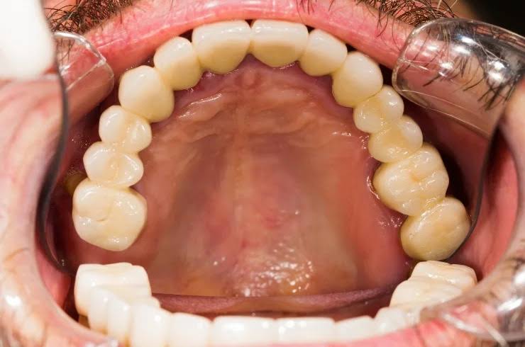 Dental Crowns and Bridges product image