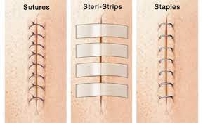 If you have abdominal surgery, complete recovery can take six to eight weeks. Caring For Your Child S Incision