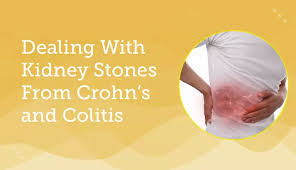 Dealing With Kidney Stones From Crohn S And Colitis Mycrohnsandcolitisteam