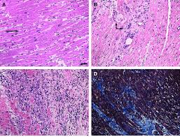 The duration of problems can vary from hours to months. Histologic Classification Of Fulminant Myocarditis By The Dallas Download Scientific Diagram