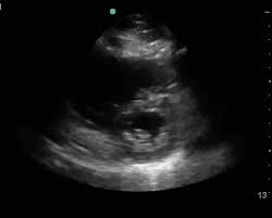 Man unterscheidet akute von chronischen formen der herzmuskelentzündung, wobei die akute myokarditis in eine chronische übergehen kann. Covid 19 And Point Of Care Echocardiography Clarius Mobile Health