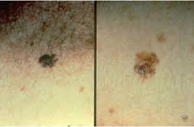 Skin cancer diagnosis always requires a skin biopsy Skin Cancer Diagnosis And Treatment Victoria Cavalli Md Berkshire County North Adams Ma