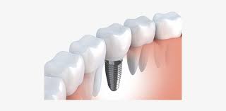 dental implants 1 implante de muelas transparent png 500x332 free download on nicepng implante de muelas transparent png