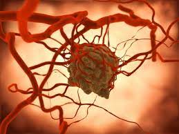 Hirntumor Ursachen Symptome Behandlung Medlexi De